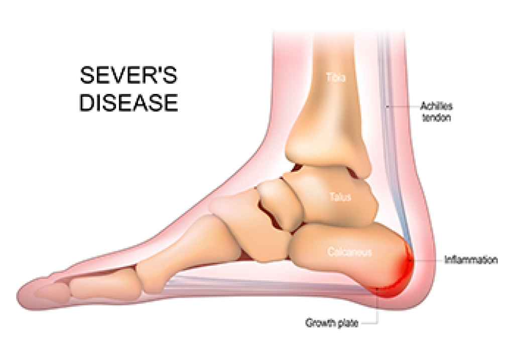 Understanding the Causes of Sever’s Disease