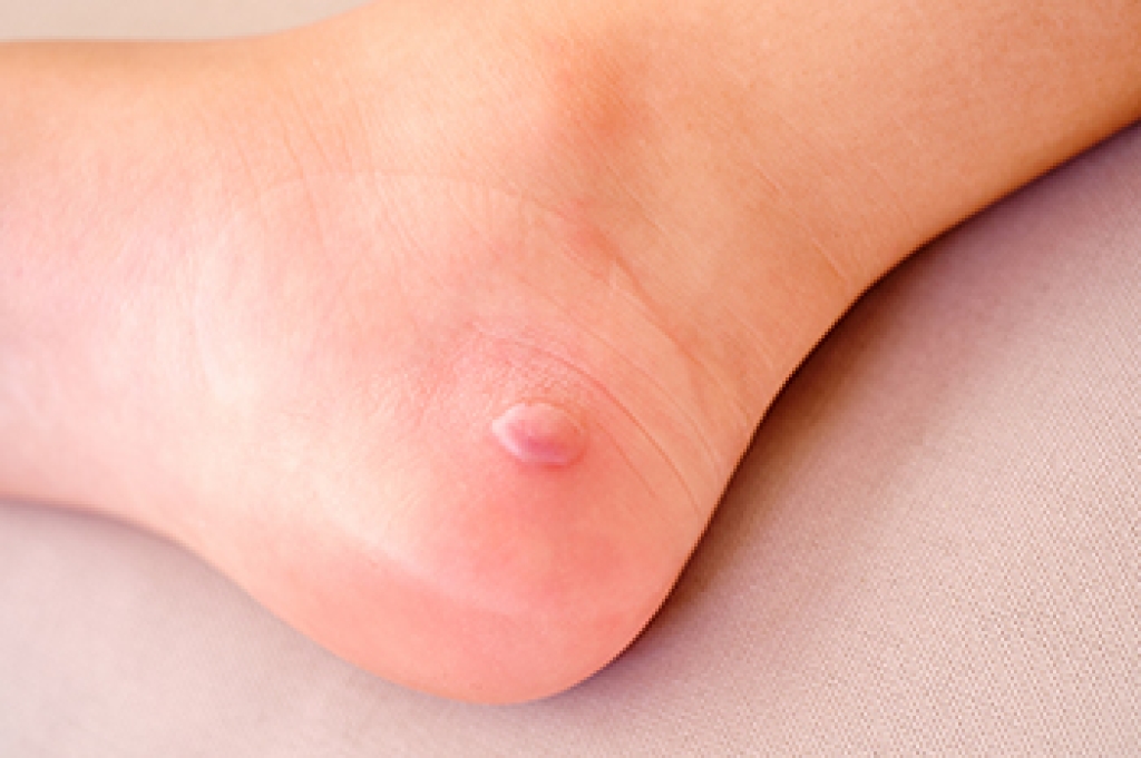Diabetic Foot Blisters and Why They Develop