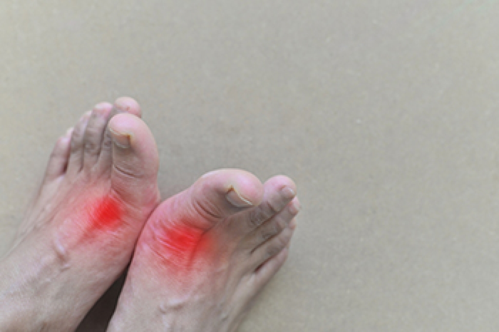 Definition and Risk Factors of Gout
