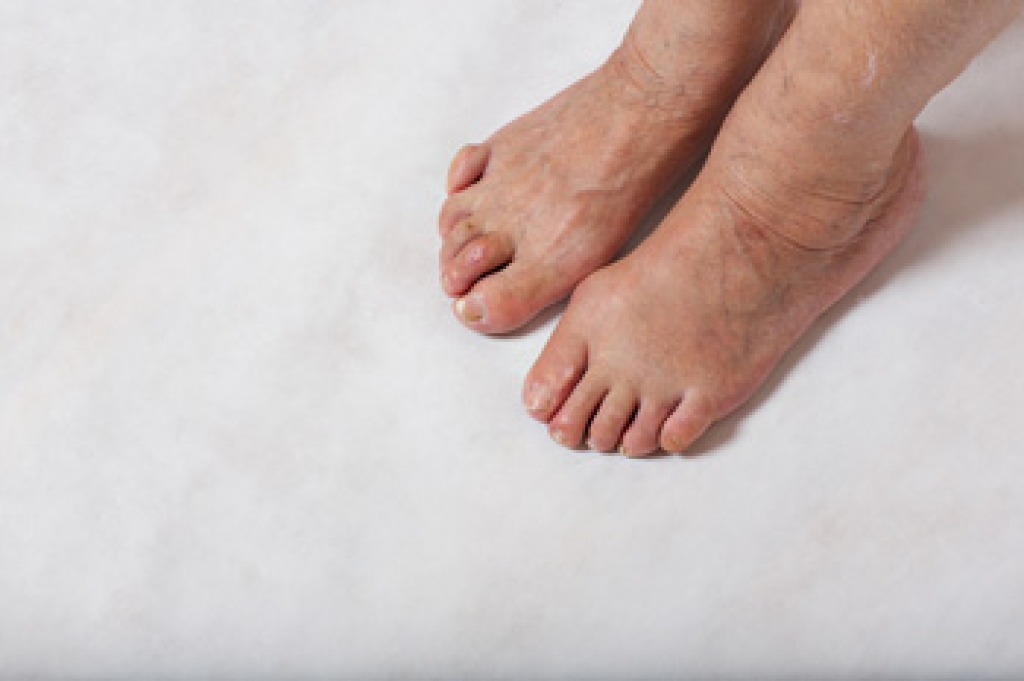Understanding Hammertoe and Toe Pain