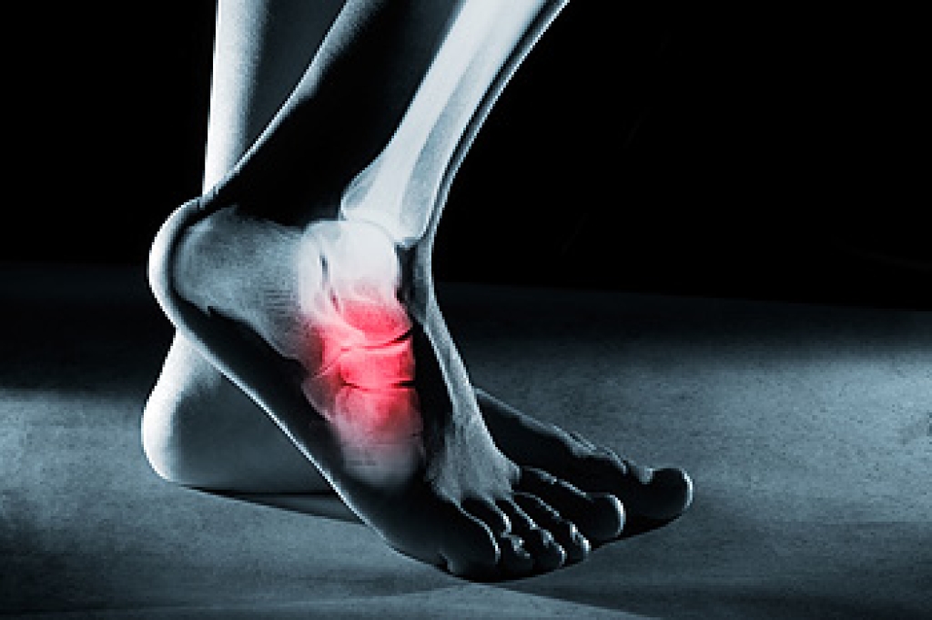 Facts About Foot Stress Fractures