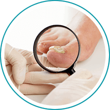 Fungal Toenails Treatment in the Norfolk County, MA: Milton (Quincy, Brookline, Weymouth, Braintree, Needham, Norwood, Wellesley, Stoughton, Dedham) areas