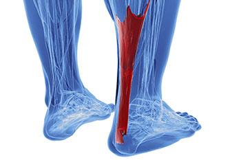Achilles tendon treatment in the Norfolk County, MA: Milton (Quincy, Brookline, Weymouth, Braintree, Needham, Norwood, Wellesley, Stoughton, Dedham) areas
