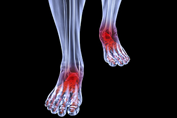 Arthritic foot care in the Norfolk County, MA: Milton (Quincy, Brookline, Weymouth, Braintree, Needham, Norwood, Wellesley, Stoughton, Dedham) areas