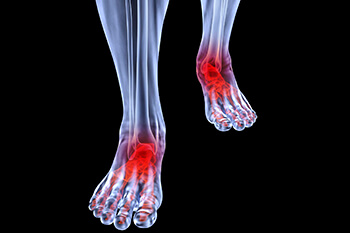 Arthritic foot care in the Norfolk County, MA: Milton (Quincy, Brookline, Weymouth, Braintree, Needham, Norwood, Wellesley, Stoughton, Dedham) areas