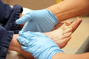 Diabetic foot treatment in the Norfolk County, MA: Milton (Quincy, Brookline, Weymouth, Braintree, Needham, Norwood, Wellesley, Stoughton, Dedham) areas