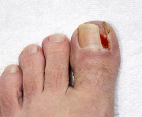 Ingrown toenail treatment in the Norfolk County, MA: Milton (Quincy, Brookline, Weymouth, Braintree, Needham, Norwood, Wellesley, Stoughton, Dedham) areas