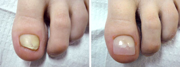 Keryflex nail restoration system in the Norfolk County, MA: Milton (Quincy, Brookline, Weymouth, Braintree, Needham, Norwood, Wellesley, Stoughton, Dedham) areas