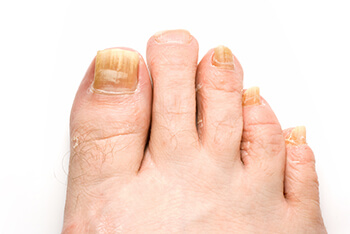 Toenail fungus treatment in the Norfolk County, MA: Milton (Quincy, Brookline, Weymouth, Braintree, Needham, Norwood, Wellesley, Stoughton, Dedham) areas