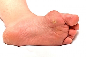 Treatment and Prevention for Corns