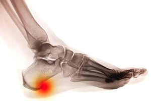 Heel Spur Facts