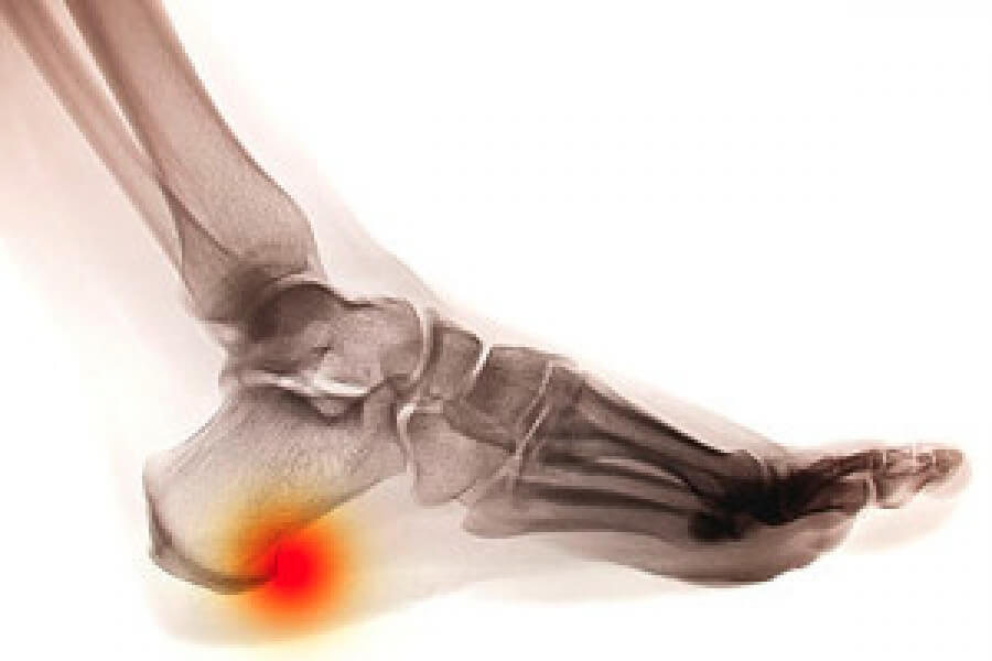 A sales heel spur