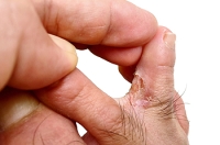 What Is Athlete’s Foot?