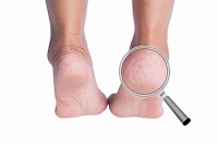 When to See a Doctor for Dry Heels