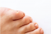 Common Causes of Foot Corns