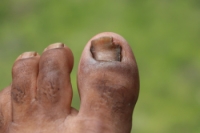 Managing and Preventing Toenail Fungus