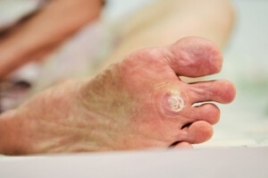 Fungus Can Cause Plantar Warts